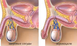 Простатит и варикоцеле – симптомы и лечение