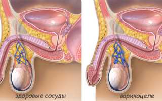 Простатит и варикоцеле – симптомы и лечение