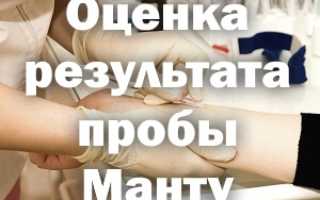 Оценка результатов пробы Манту