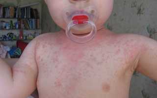 Повышенная температура и красные пятна на теле ребенка: возможные причины