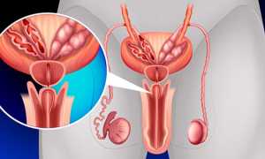 Кальцинаты в предстательной железе – как лечить камни в простате