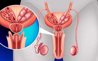 Кальцинаты в предстательной железе – как лечить камни в простате