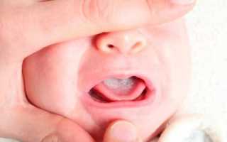 У ребенка белый налет на языке при температуре: причины и способы лечения