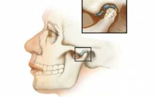 Симптомы и лечение артрита челюстно-лицевого сустава