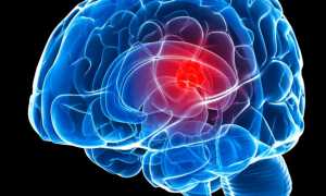 Из-за чего образуется менингиома головного мозга, чем опасно образование
