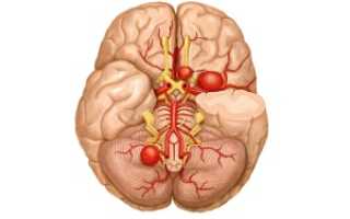 Причины аневризма сосудов головного мозга и её последствия